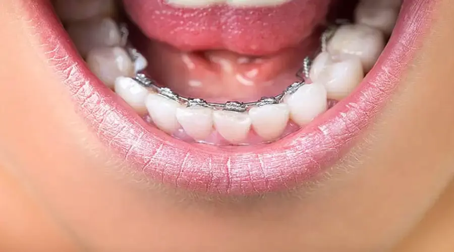 ارتودنسی نامرئی از پشت دندان