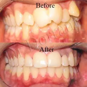 موارد رایج ناهنجاریهای دندانی ارتودنسی